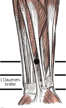 Lokalisation von Pc-6; als Vorlage dient ein Bild aus 'Gray's Anatomy of the Human body, 1918', dessen Copyright abgelaufen ist. Aus de.wikipedia.org